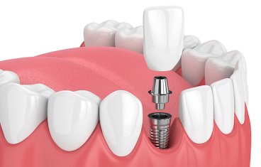 Illustration of advanced dental implants