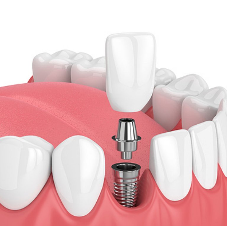 Dental implants illiustration